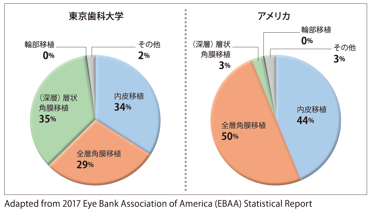 角膜移植手術のトレンド