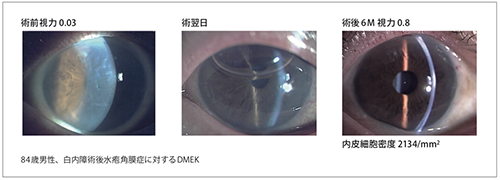角膜移植手術のトレンド